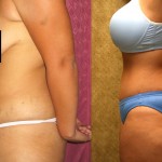 Tummy Tuck (Abdominoplasty) Small Size Before & After Patient #5990