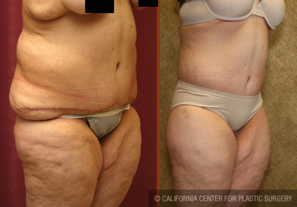 Body Lift Before & After Patient #6047