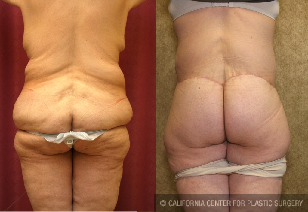 Body Lift Before & After Patient #6047