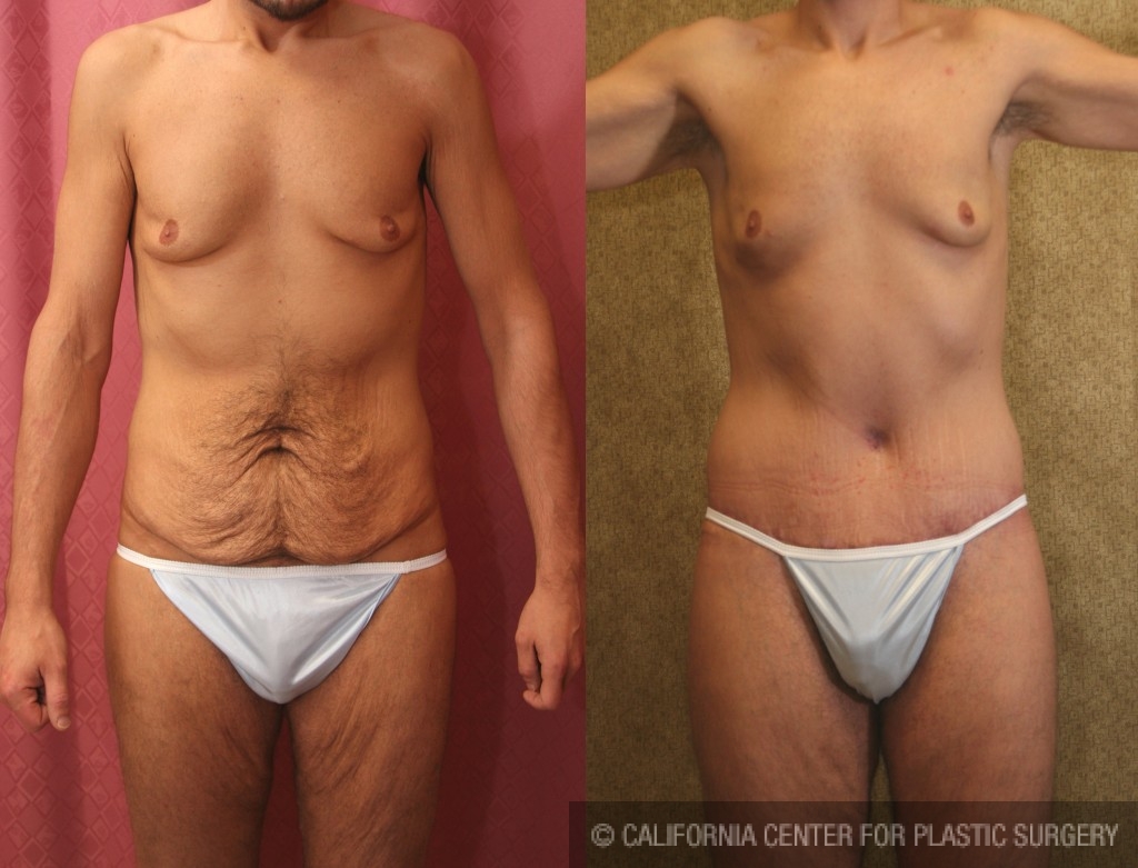 Male Tummy Tuck (abdominoplasty) Before & After Patient #6019