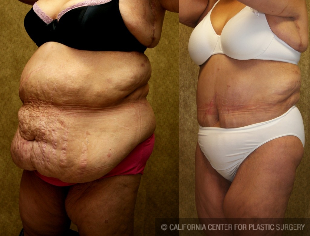 Patient #5898 Tummy Tuck (Abdominoplasty) Plus Size Before and
