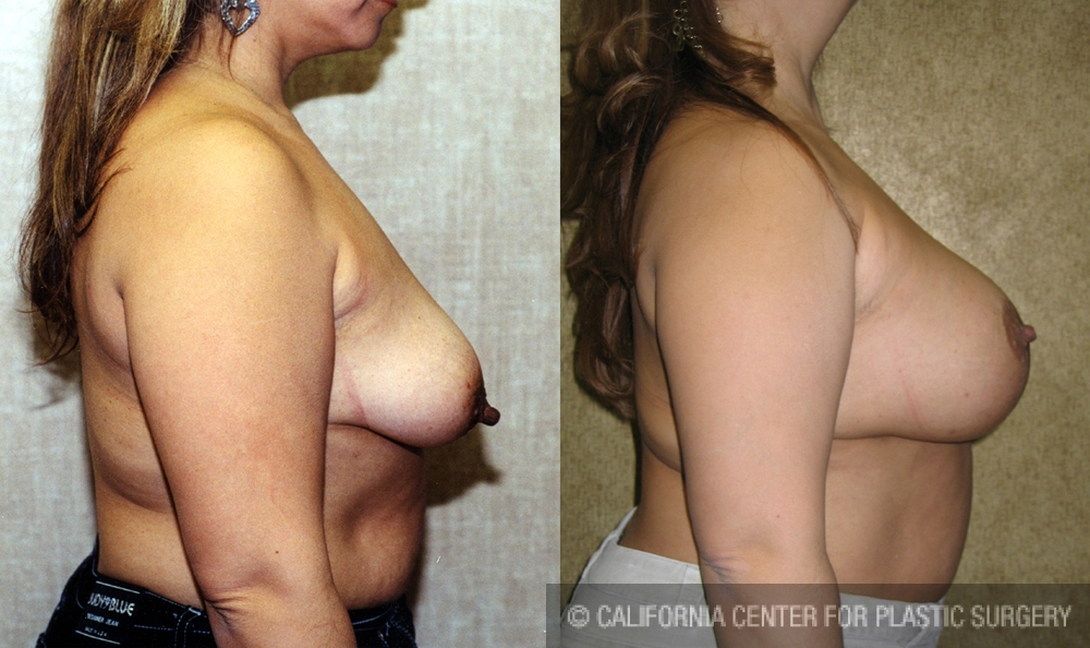 Breast Lift - Full Before & After Patient #6937