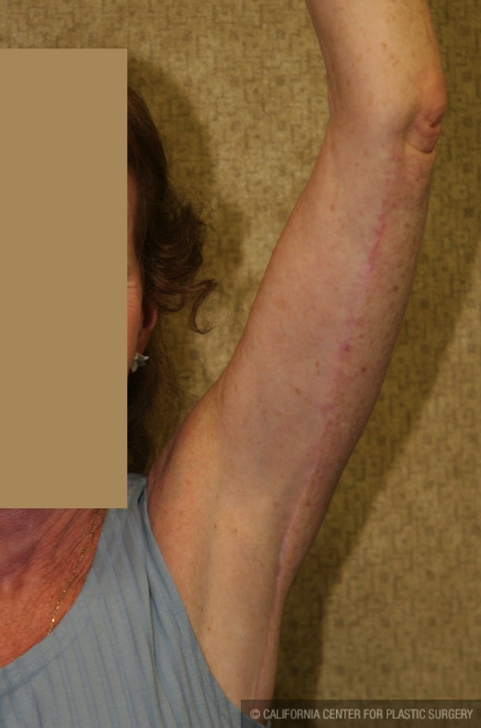 Arm Lift (Brachioplasty) Before & After Patient #6141