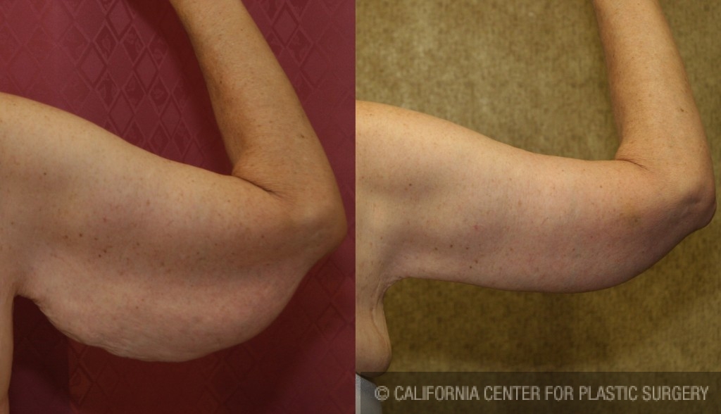 Arm Lift (Brachioplasty) Before & After Patient #6165