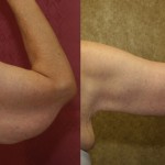 Arm Lift (Brachioplasty) Before & After Patient #6165