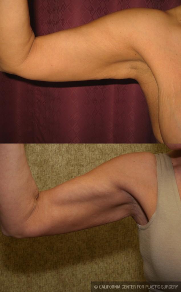 Arm Lift (Brachioplasty) Before & After Patient #6180