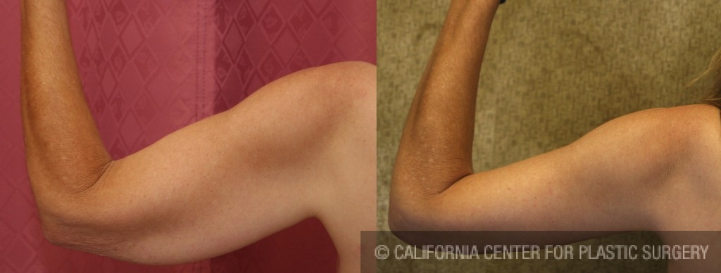 Arm Lift (Brachioplasty) Before & After Patient #6149