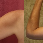 Arm Lift (Brachioplasty) Before & After Patient #6149