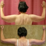 Arm Lift (Brachioplasty) Before & After Patient #6160