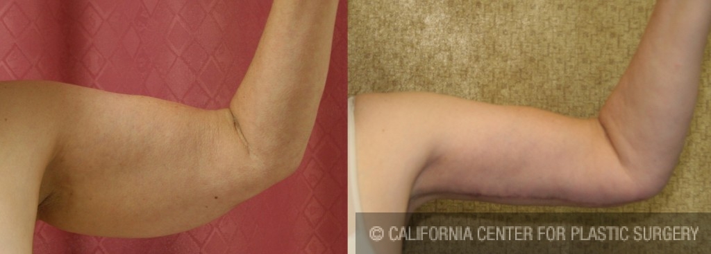 Arm Lift (Brachioplasty) Before & After Patient #6160