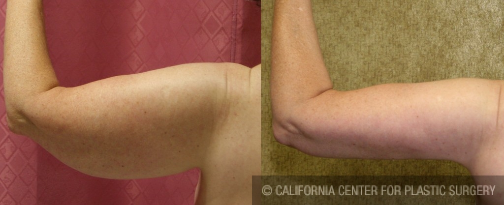 Arm Lift (Brachioplasty) Before & After Patient #6160