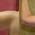 Arm Lift (Brachioplasty) Before & After Patient #6160