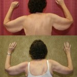 Arm Lift (Brachioplasty) Before & After Patient #6165