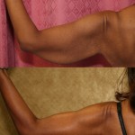 Arm Lift (Brachioplasty) Before & After Patient #6125