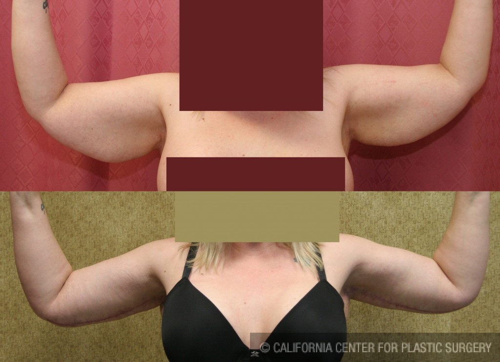 Arm Lift (Brachioplasty) Before & After Patient #6177