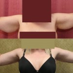 Arm Lift (Brachioplasty) Before & After Patient #6177