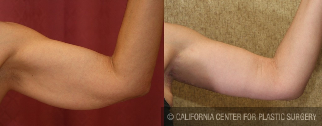 Arm Lift (Brachioplasty) Before & After Patient #6149