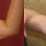 Arm Lift (Brachioplasty) Before & After Patient #6149