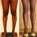 Calf Augmentation Before & After Patient #6869