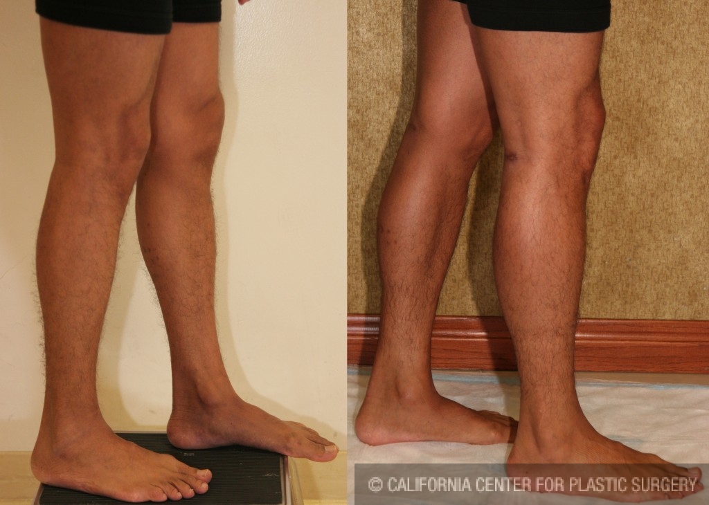 Calf Augmentation Before & After Patient #6874