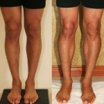 Calf Augmentation Before & After Patient #6874