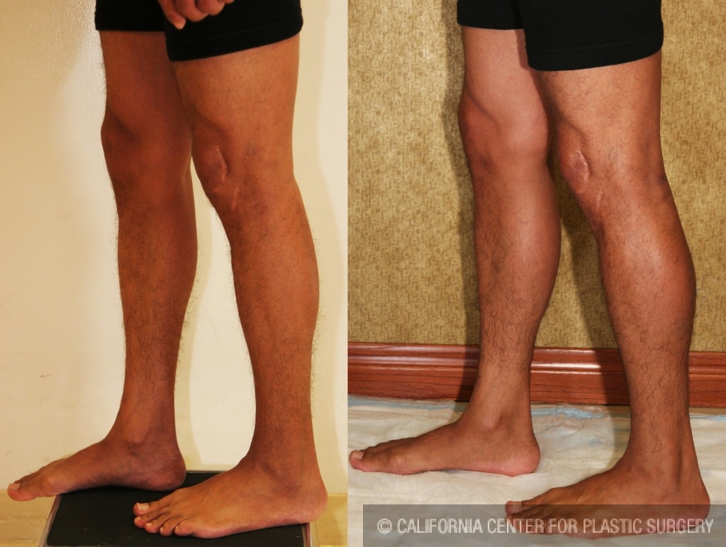 Calf Augmentation Before & After Patient #6874