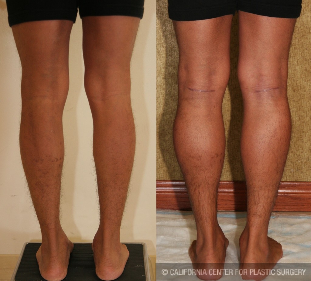 Calf Augmentation Before & After Patient #6874