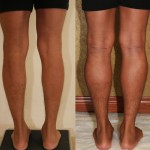 Calf Augmentation Before & After Patient #6874