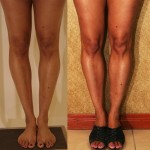 Calf Augmentation Before & After Patient #6892