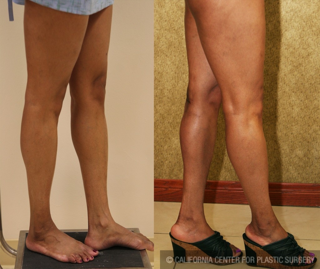 Calf Augmentation Before & After Patient #6892