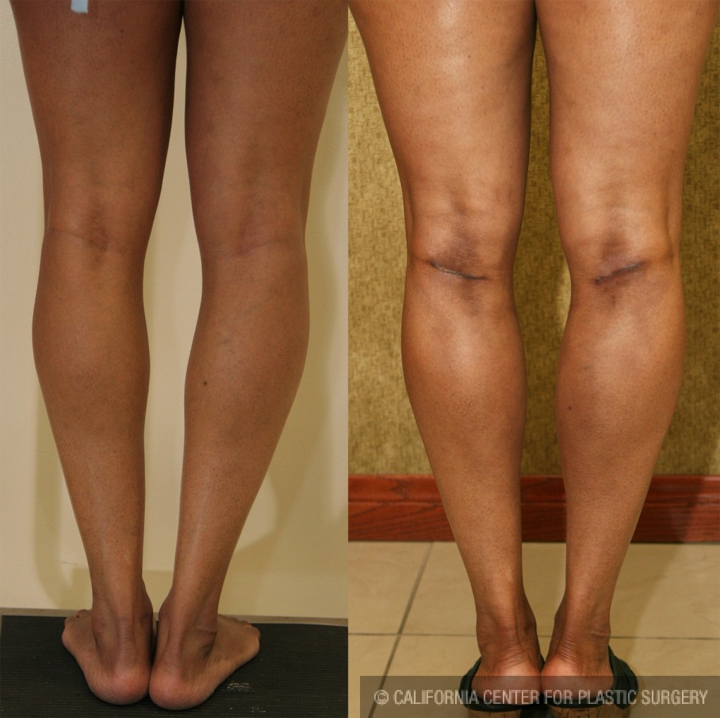 Calf Augmentation Before & After Patient #6892