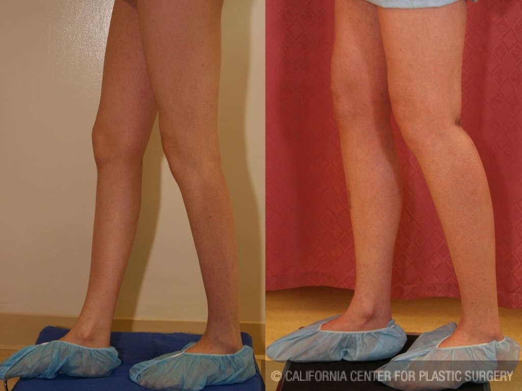 Calf Augmentation Before & After Patient #6887