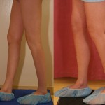 Calf Augmentation Before & After Patient #6887