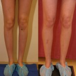 Calf Augmentation Before & After Patient #6887