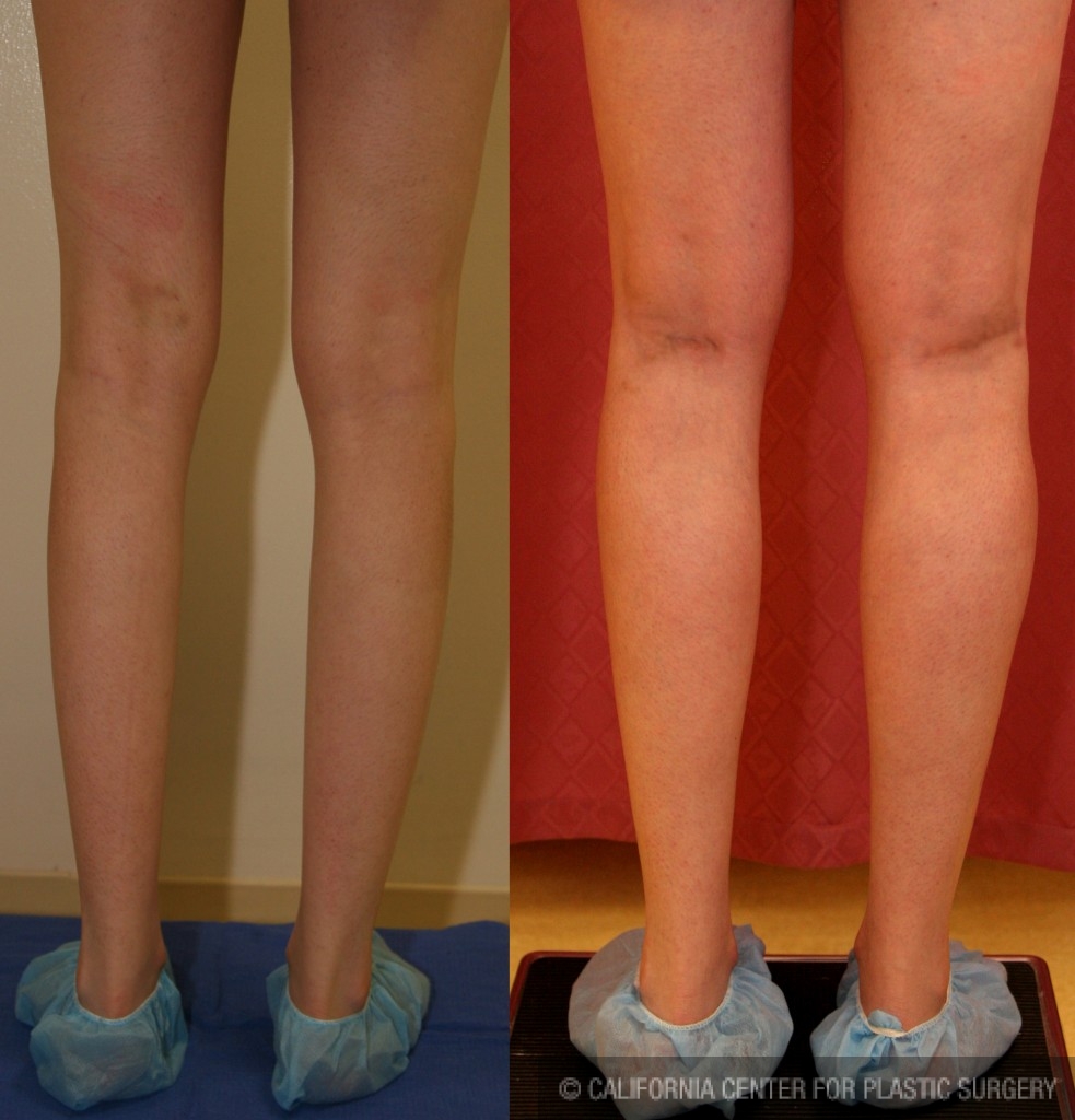 Calf Augmentation Before & After Patient #6887