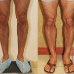 Calf Augmentation Before & After Patient #6883