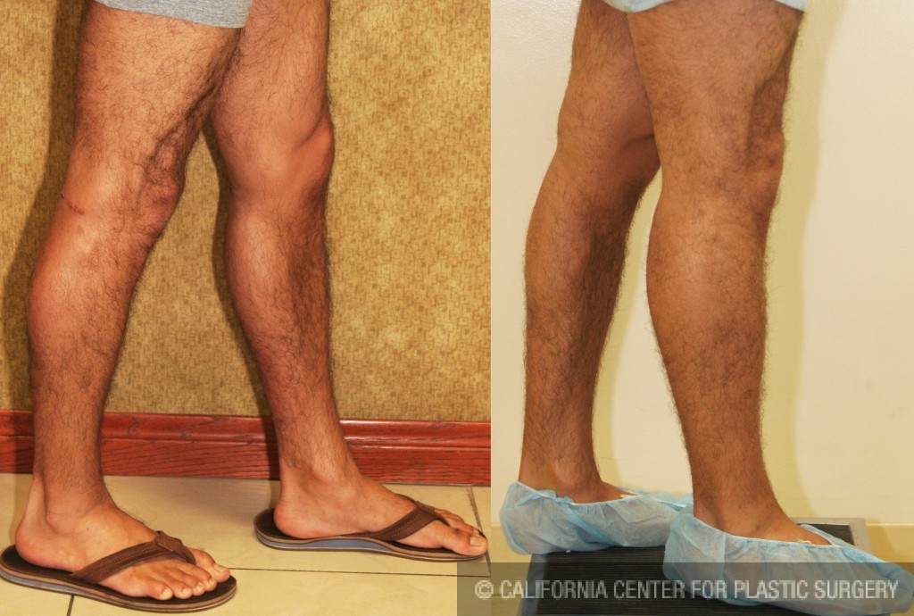 Calf Augmentation Before & After Patient #6883
