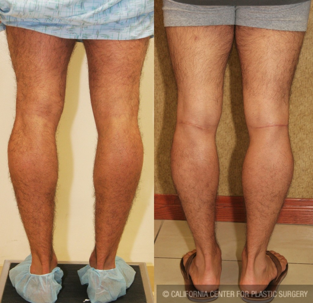 Calf Augmentation Before & After Patient #6883