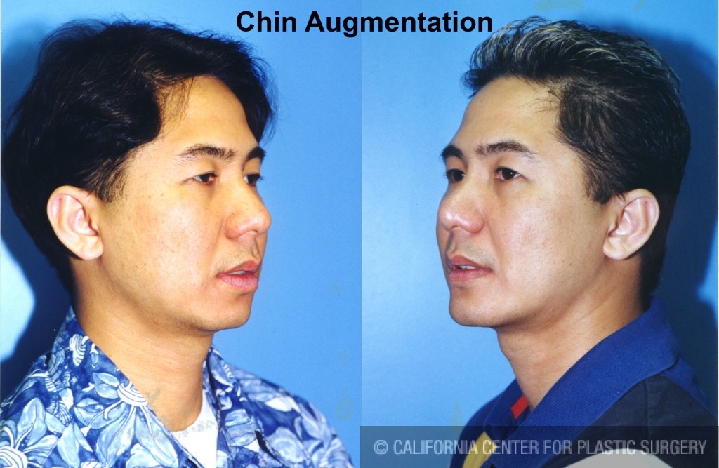 Chin Augmentation Before & After Patient #6799