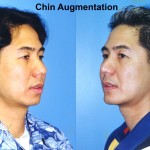 Chin Augmentation Before & After Patient #6799