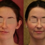 Ear (Otoplasty) Before & After Patient #6439
