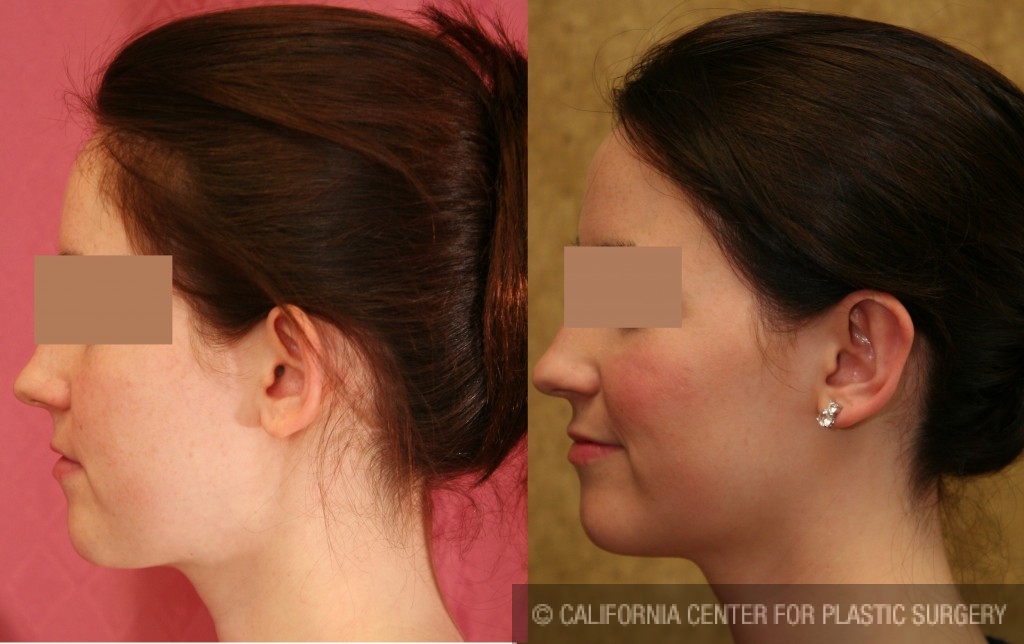 Ear (Otoplasty) Before & After Patient #6439