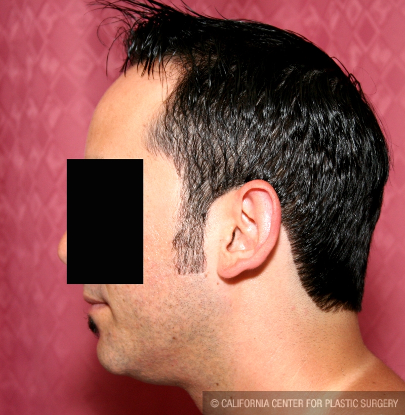 Ear (Otoplasty) Before & After Patient #6451