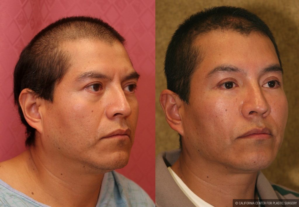 Eyelid (Blepharoplasty) Before & After Patient #10460
