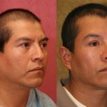 Eyelid (Blepharoplasty) Before & After Patient #10460