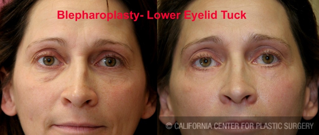 Eyelid (Blepharoplasty) Before & After Patient #6523