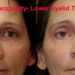 Eyelid (Blepharoplasty) Before & After Patient #6523