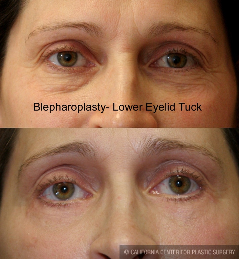 Eyelid (Blepharoplasty) Before & After Patient #6523