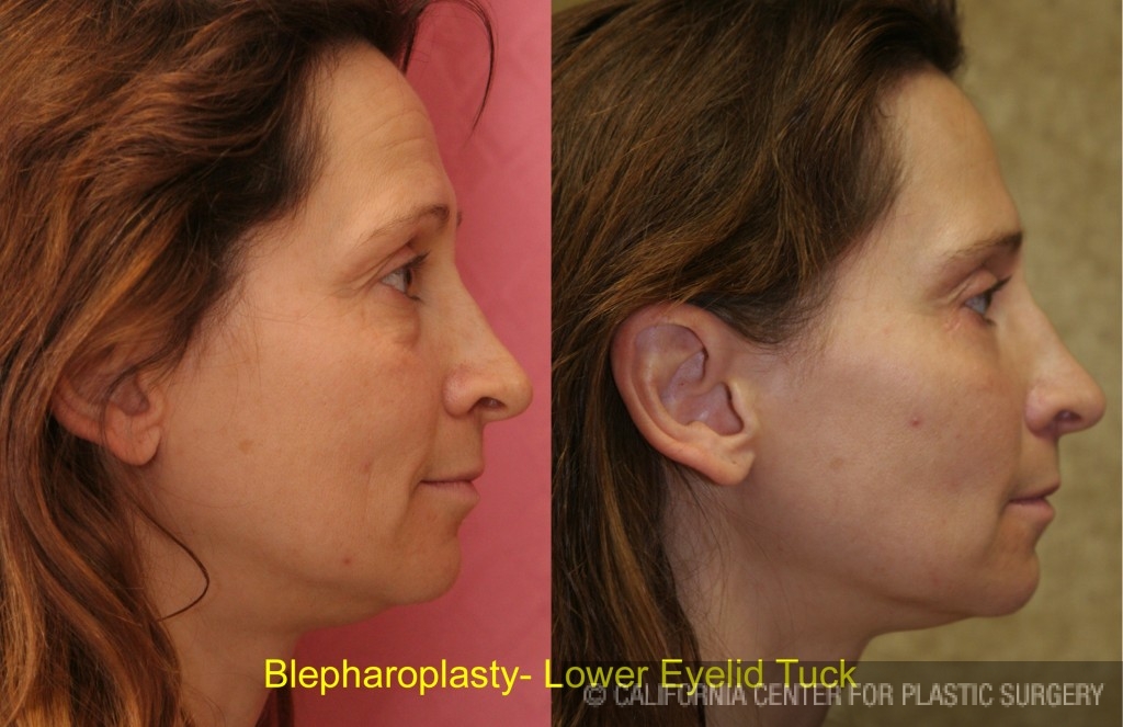 Eyelid (Blepharoplasty) Before & After Patient #6523
