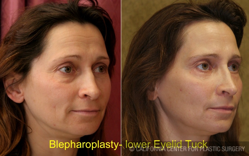 Eyelid (Blepharoplasty) Before & After Patient #6523